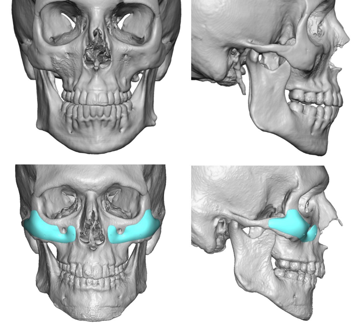 Total jaw implant